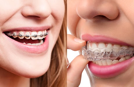 Transform Your Smile With Damon Braces or Invisalign!