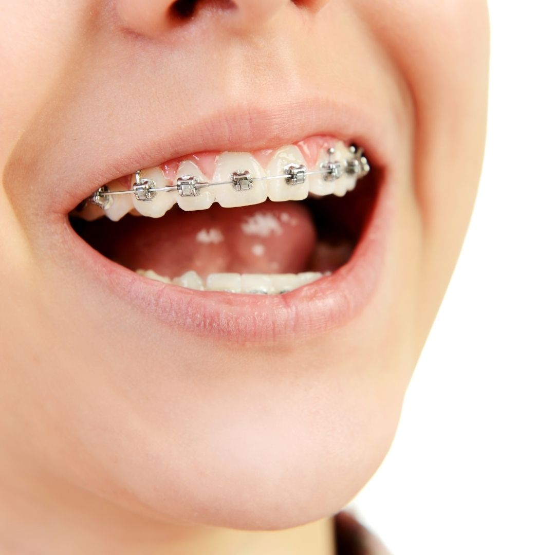 This is the image for the news article titled How to Find the Best Orthodontist For Your Child