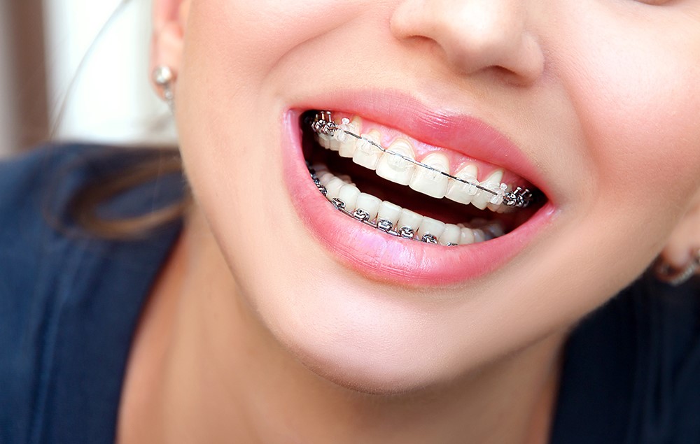 This is the image for the news article titled Are All Braces the Same? 