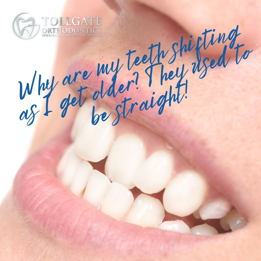 This is the image for the news article titled Why Are My Teeth Shifting? They Used to Be Straight!